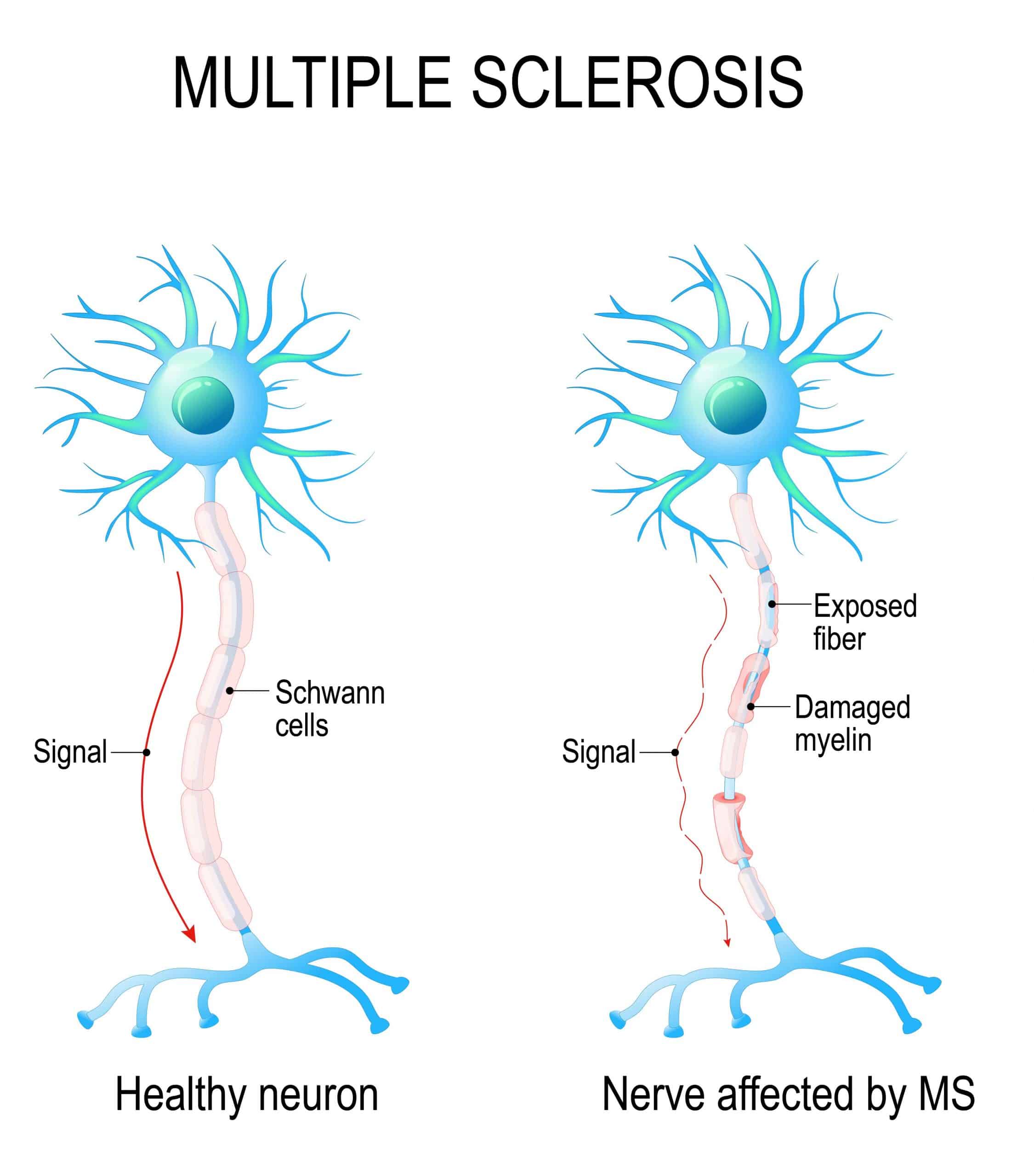 Multiple Sclerosis Overview Signs Symptoms Types Multiple Sclerosis or Illustration 